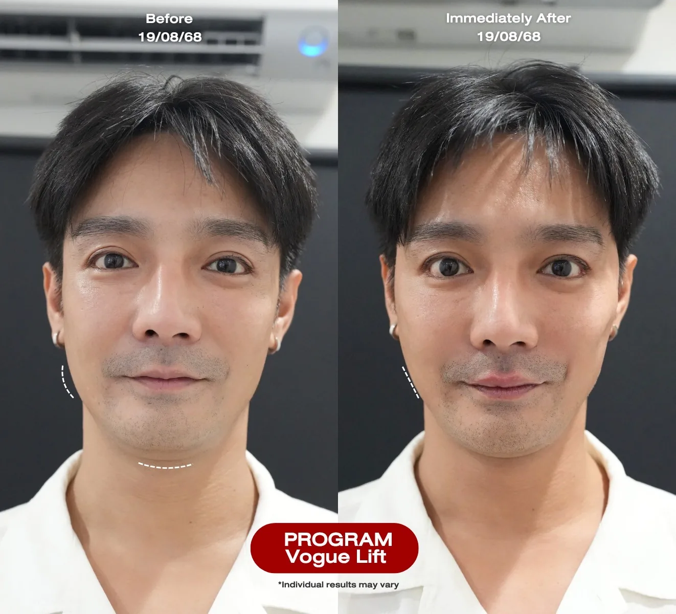 日本人俳優のお客様 — Vogue Lift プログラム ビフォーアフター(施術直後)